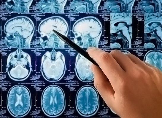Brain Cancer Radiation Protection - airestech